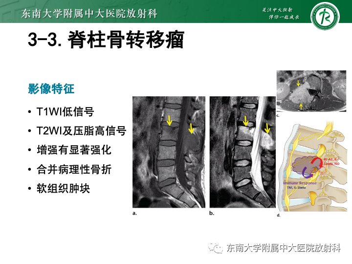 【PPT】下腰痛相关疾病的影像表现-40