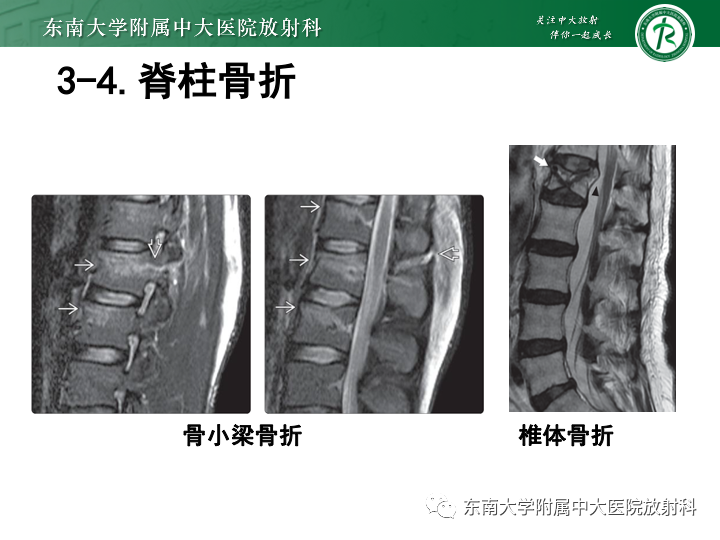 【PPT】下腰痛相关疾病的影像表现-42