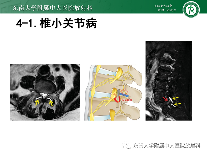 【PPT】下腰痛相关疾病的影像表现-44