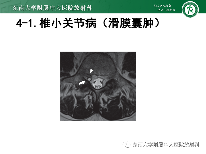 【PPT】下腰痛相关疾病的影像表现-45