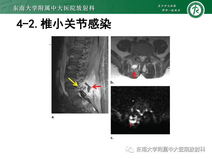 【PPT】下腰痛相关疾病的影像表现-46