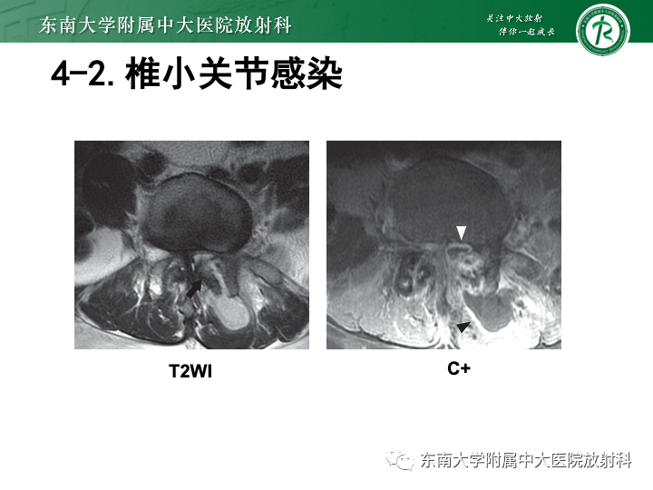 【PPT】下腰痛相关疾病的影像表现-47