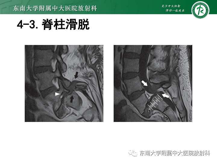 【PPT】下腰痛相关疾病的影像表现-48