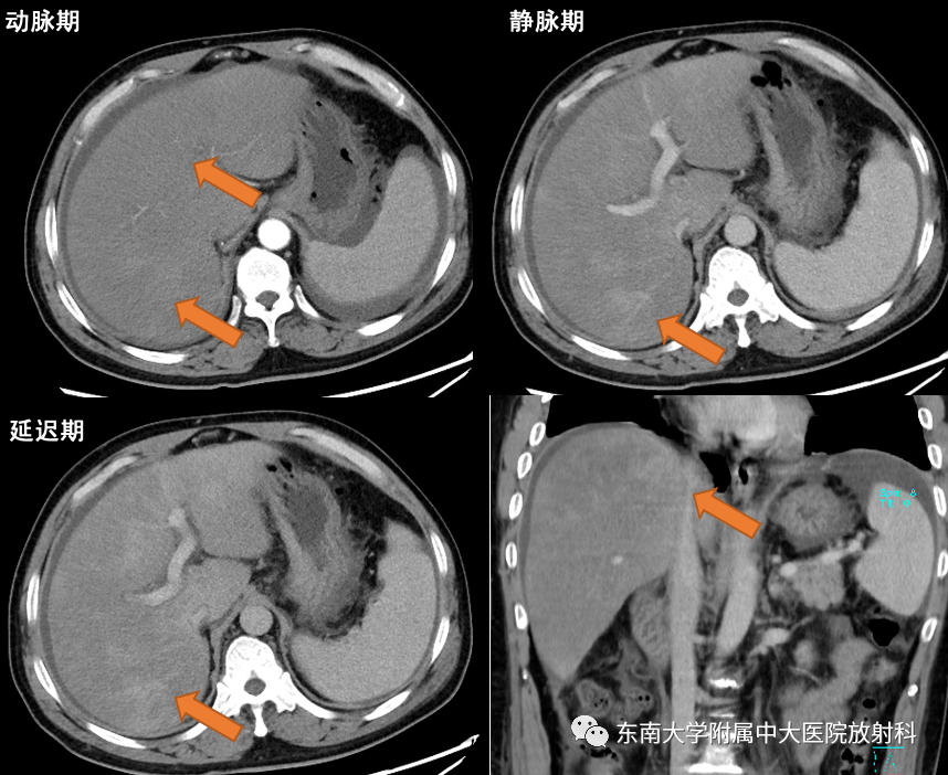 【PPT】肝窦阻塞综合征-1