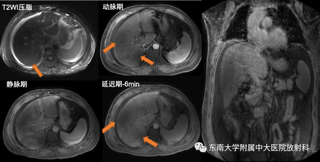 【PPT】肝窦阻塞综合征-2