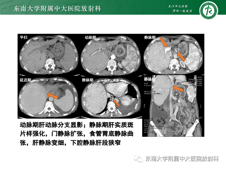 【PPT】肝窦阻塞综合征-18