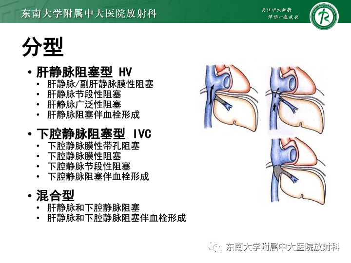 【PPT】肝窦阻塞综合征-24