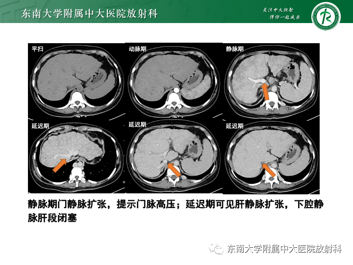 【PPT】肝窦阻塞综合征-28