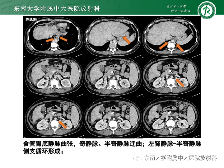 【PPT】肝窦阻塞综合征-29