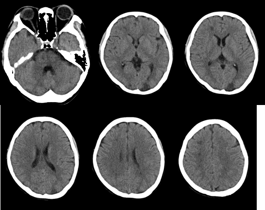 【病例】特鲁索综合征1例CT及MR影像-1