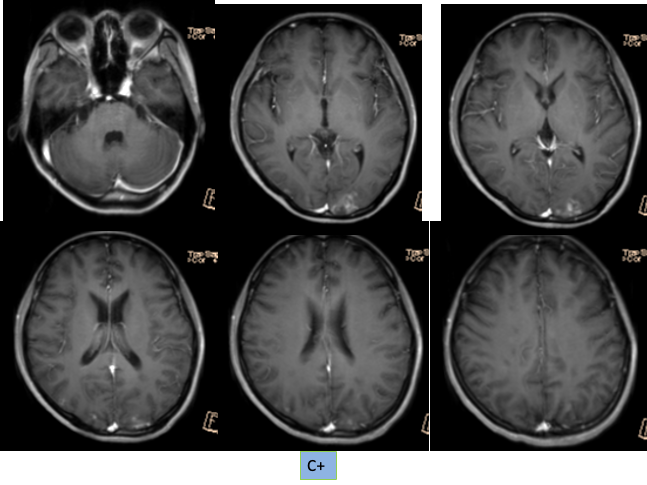 【病例】特鲁索综合征1例CT及MR影像-5