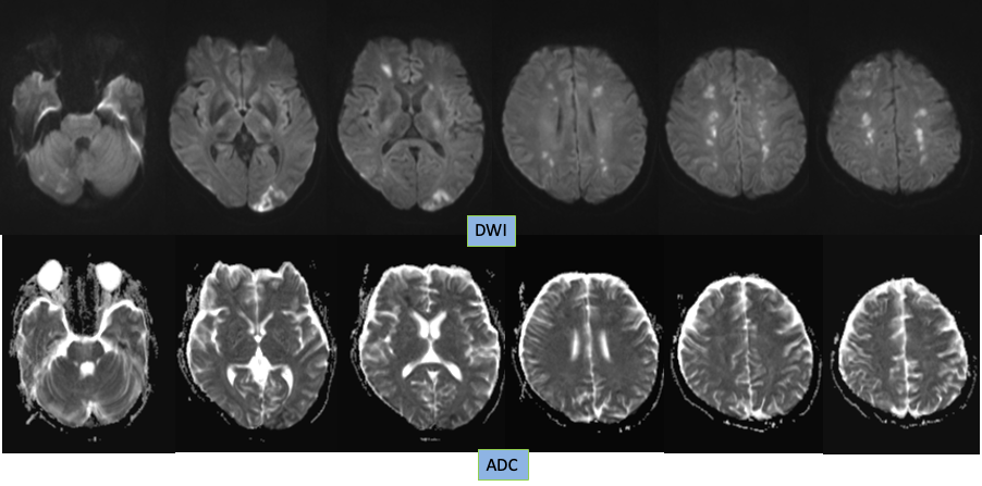 【病例】特鲁索综合征1例CT及MR影像-4