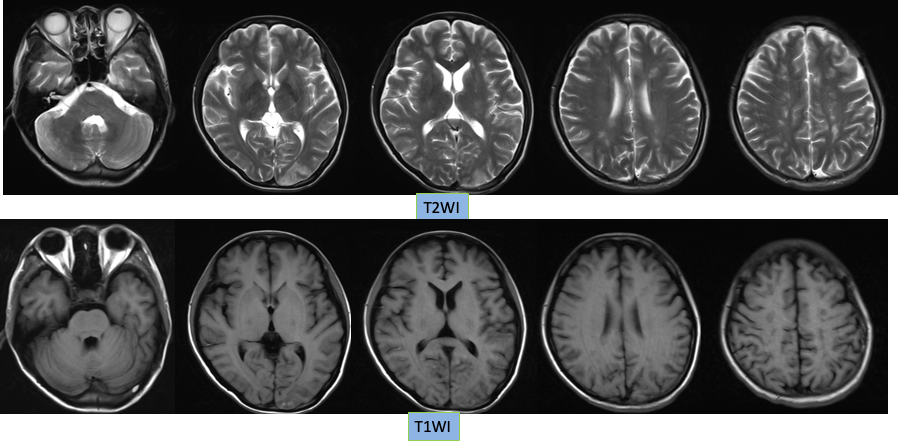 【病例】特鲁索综合征1例CT及MR影像-2