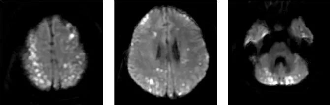 【病例】特鲁索综合征1例CT及MR影像-8
