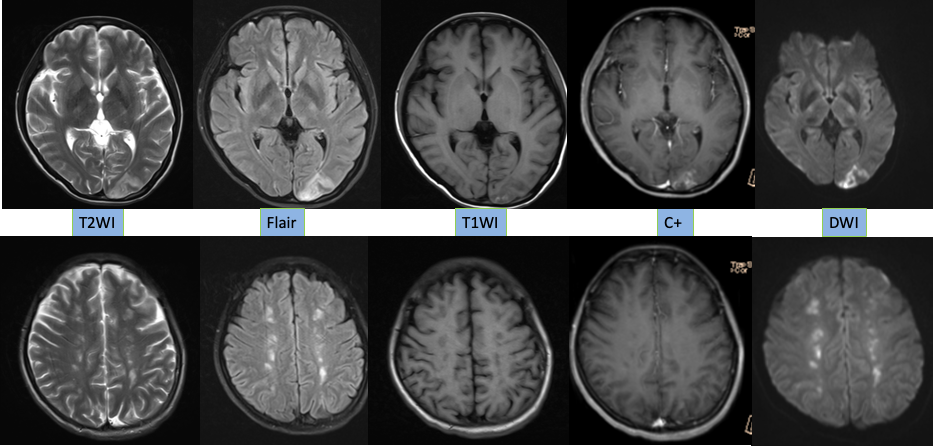 【病例】特鲁索综合征1例CT及MR影像-6