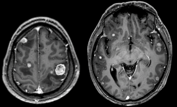 【病例】特鲁索综合征1例CT及MR影像-7