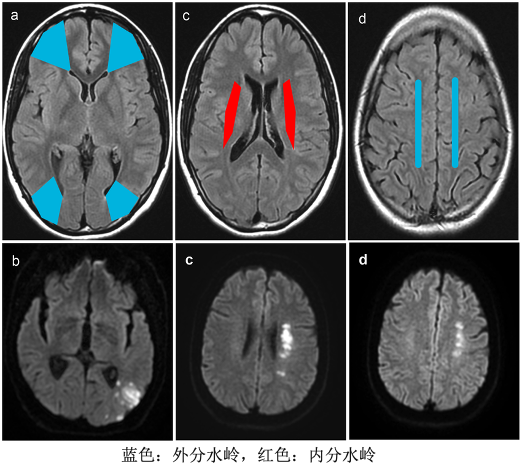 【病例】特鲁索综合征1例CT及MR影像-9