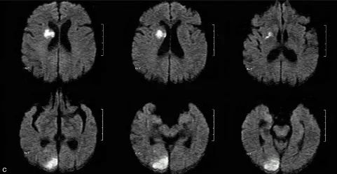 【病例】特鲁索综合征1例CT及MR影像-11