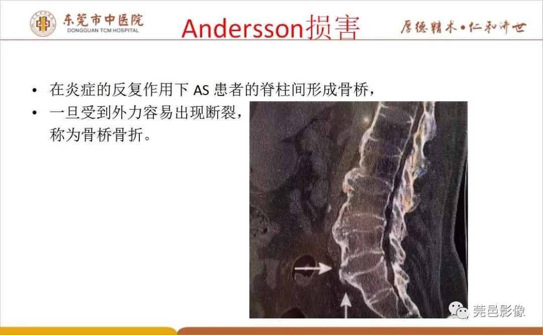 【PPT】强直性脊柱炎并Andersson损害-7