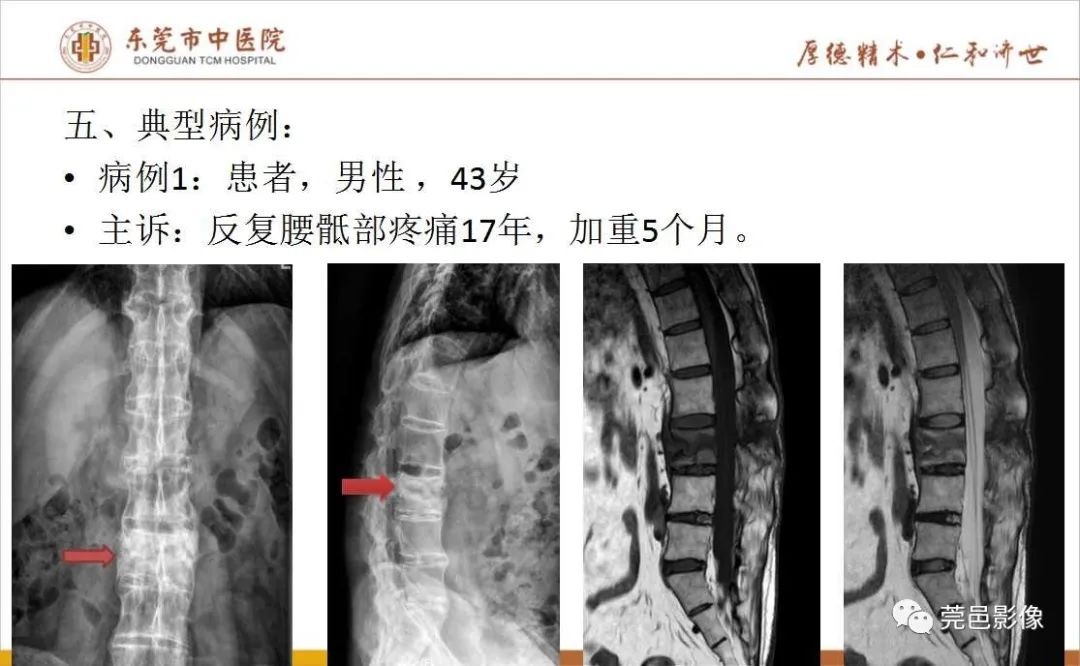 【PPT】强直性脊柱炎并Andersson损害-8