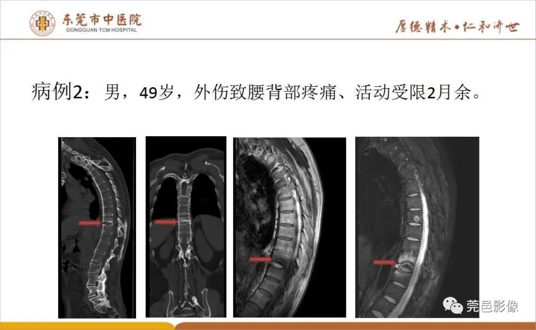 【PPT】强直性脊柱炎并Andersson损害-9