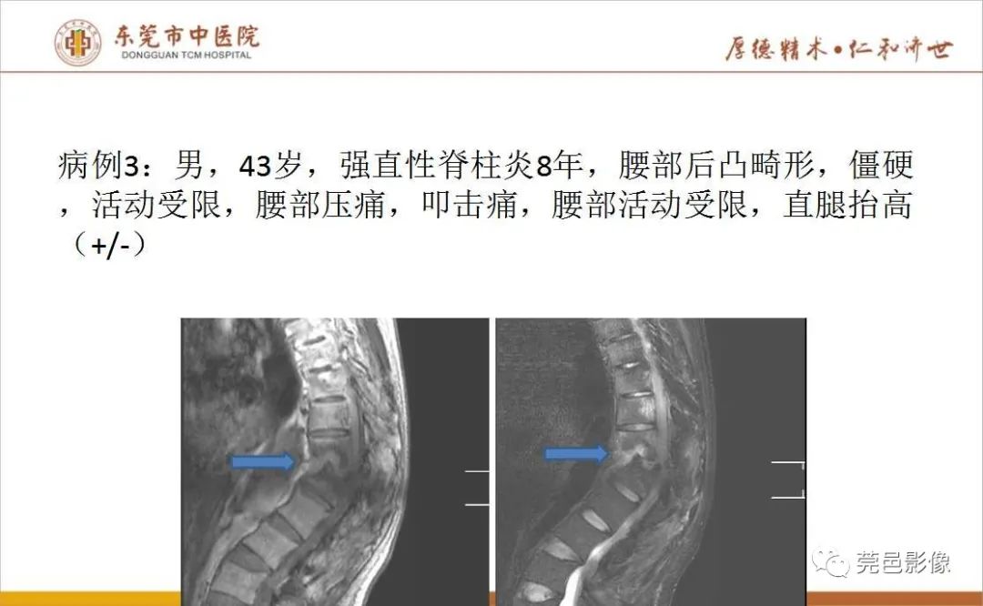 【PPT】强直性脊柱炎并Andersson损害-10