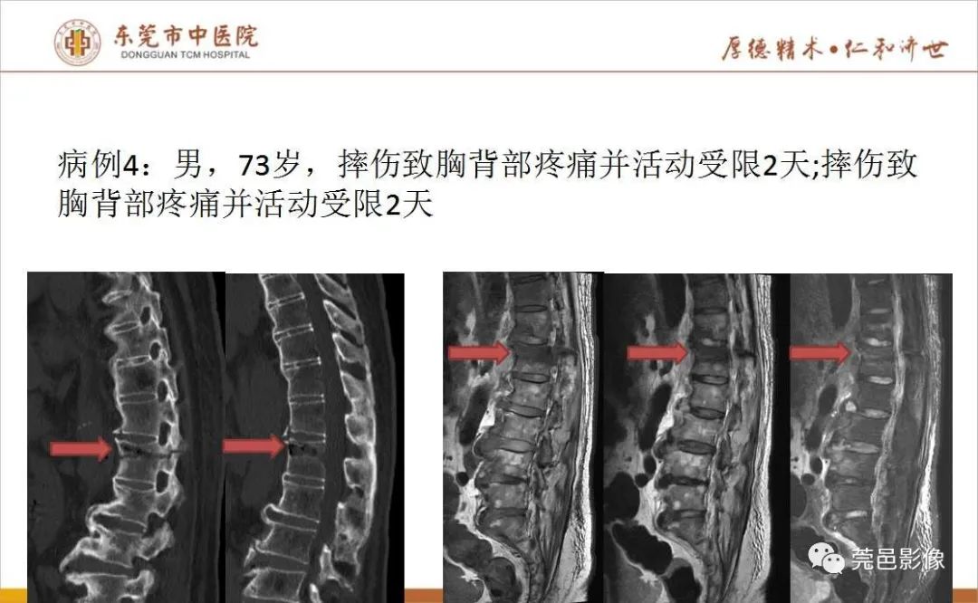 【PPT】强直性脊柱炎并Andersson损害-11