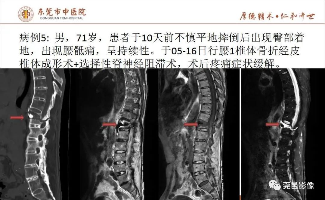 【PPT】强直性脊柱炎并Andersson损害-12