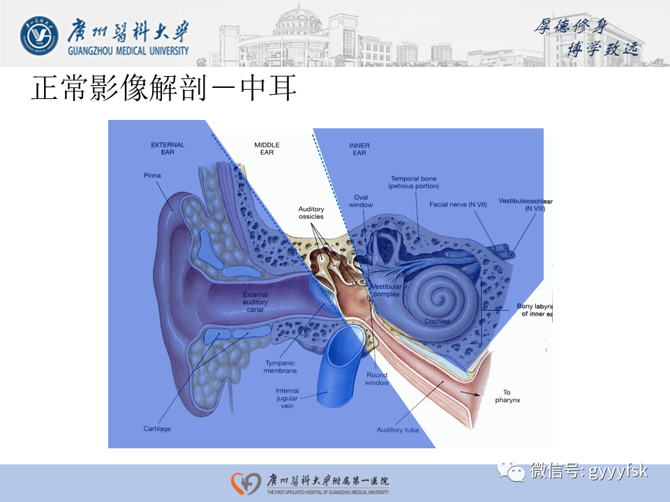 【PPT】中耳胆脂瘤影像阅片-5