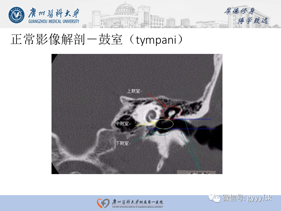 【PPT】中耳胆脂瘤影像阅片-7