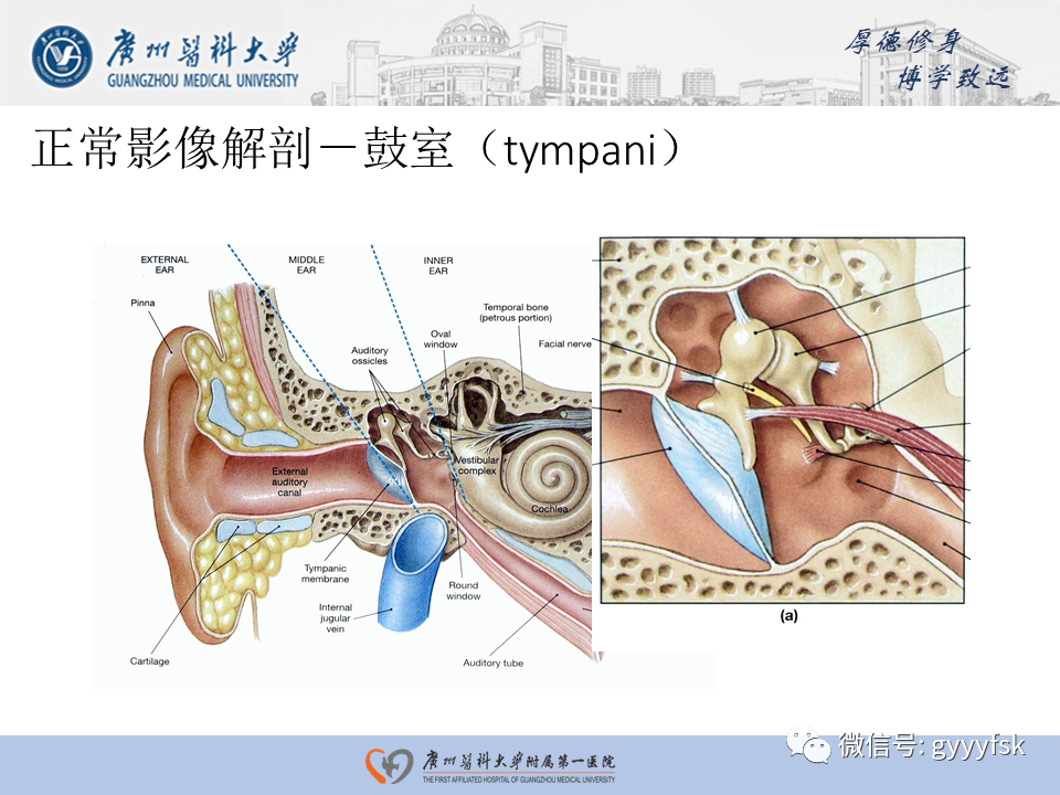 【PPT】中耳胆脂瘤影像阅片-6