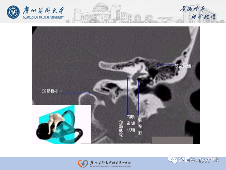 【PPT】中耳胆脂瘤影像阅片-9