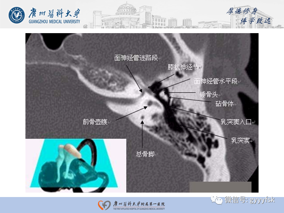 【PPT】中耳胆脂瘤影像阅片-14