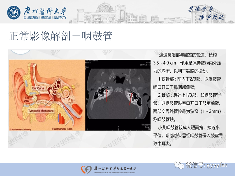 【PPT】中耳胆脂瘤影像阅片-16