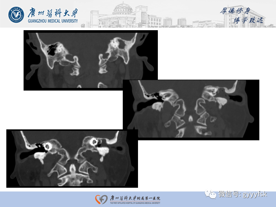 【PPT】中耳胆脂瘤影像阅片-19