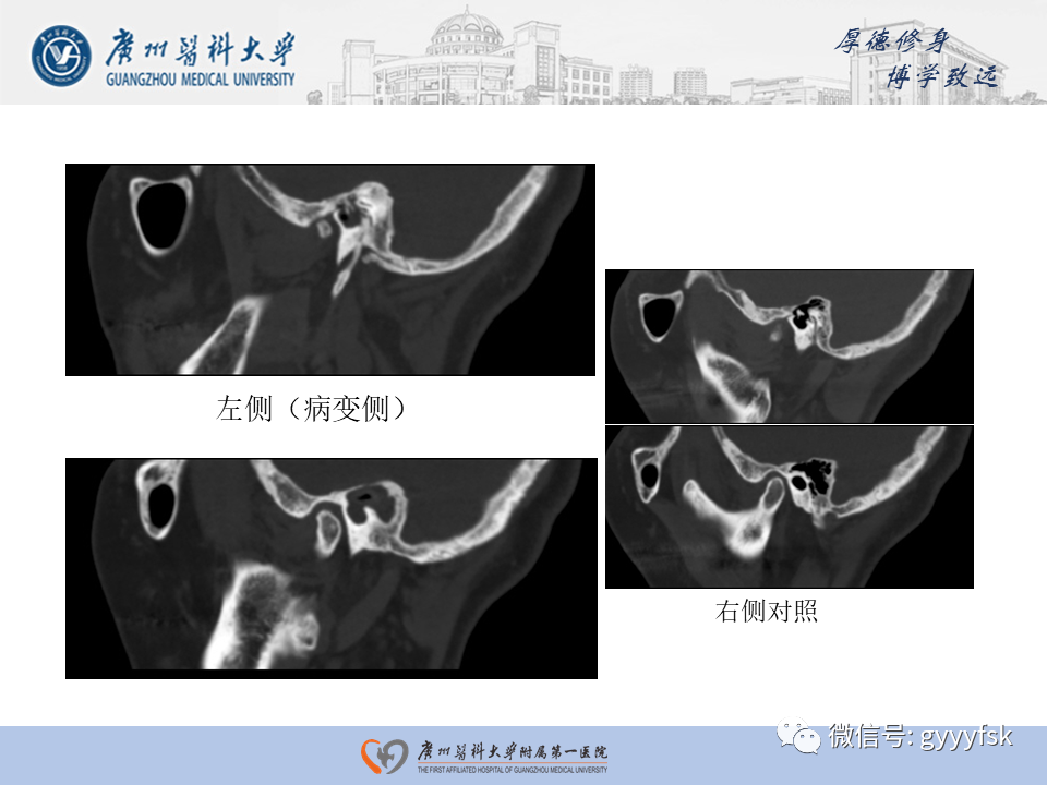 【PPT】中耳胆脂瘤影像阅片-20