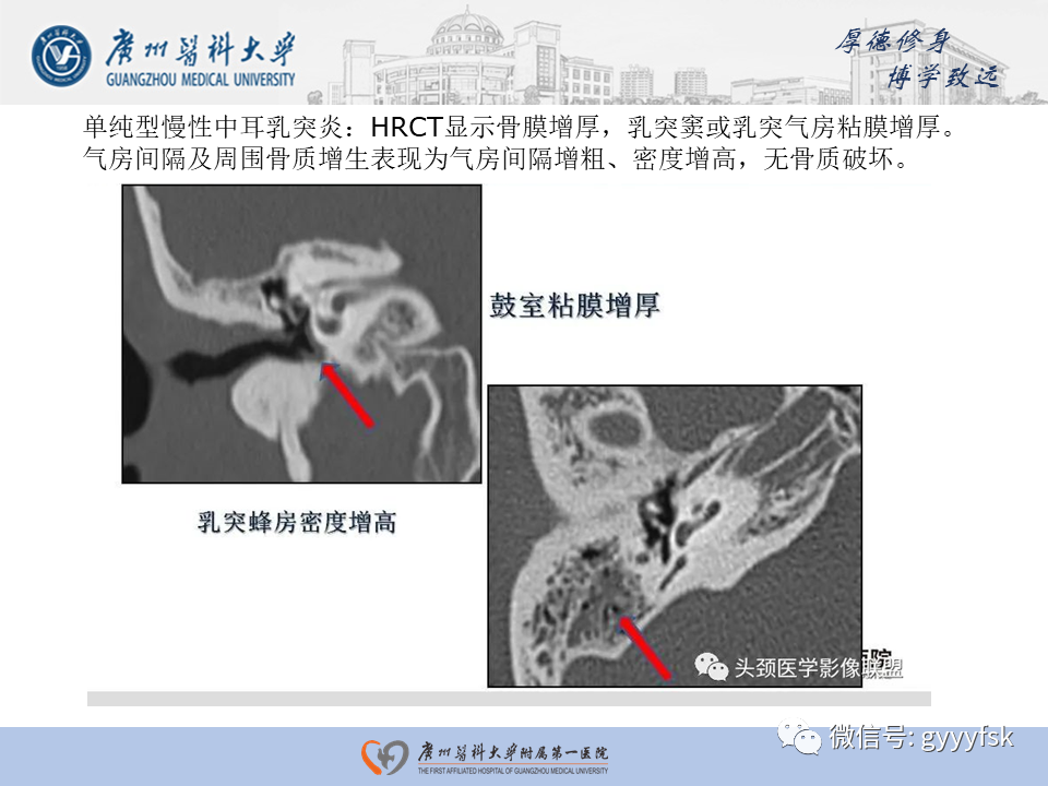 【PPT】中耳胆脂瘤影像阅片-26