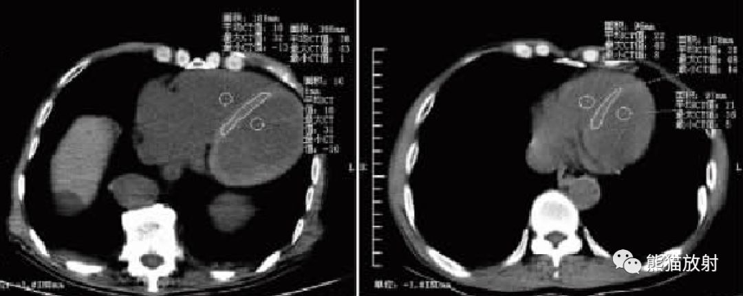 贫血—胸部CT平扫的诊断价值-2