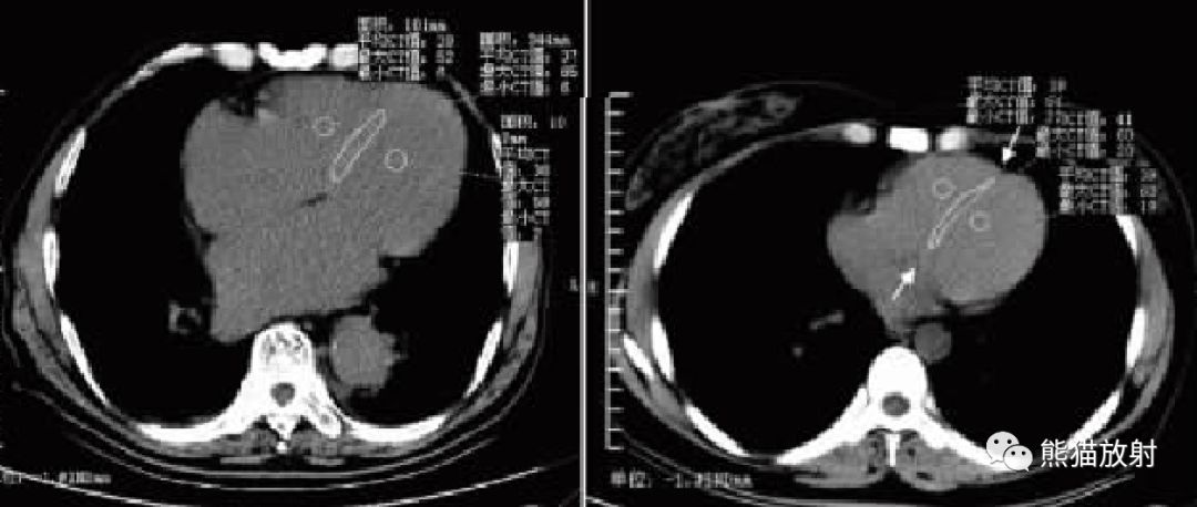 贫血—胸部CT平扫的诊断价值-3