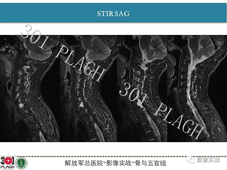 【病例】颈椎脊索瘤1例MR影像-5
