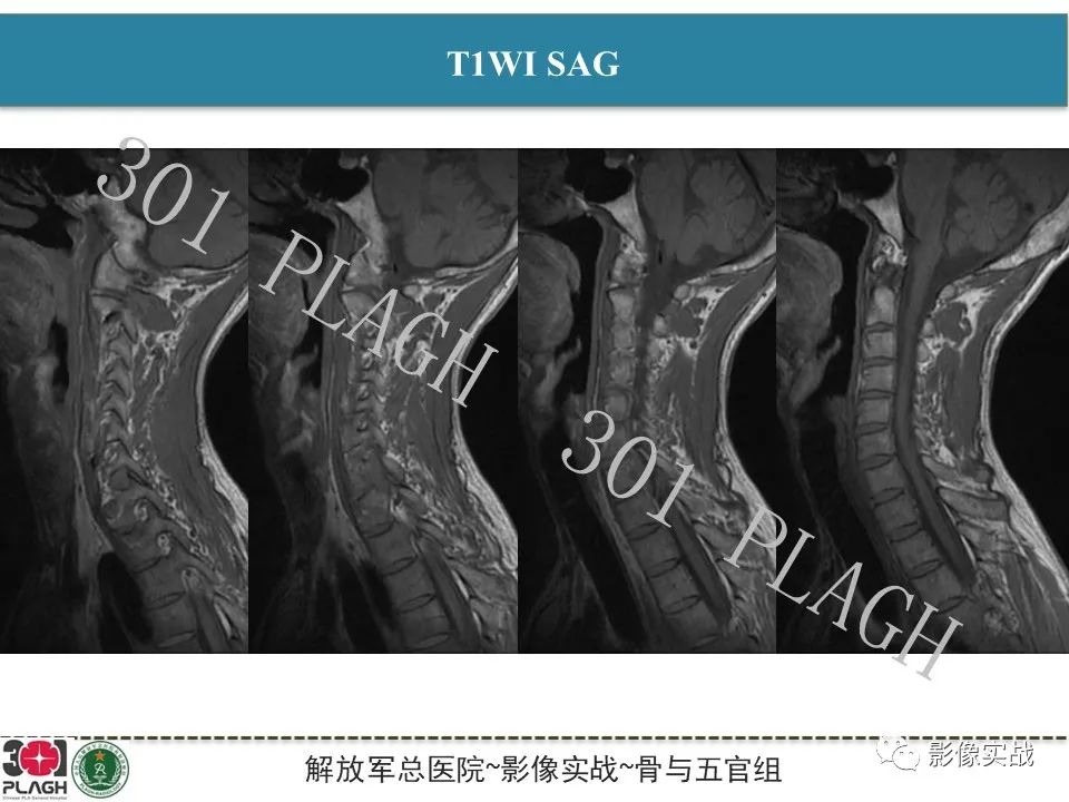 【病例】颈椎脊索瘤1例MR影像-3
