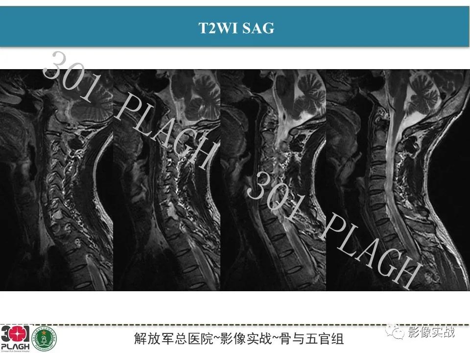 【病例】颈椎脊索瘤1例MR影像-4