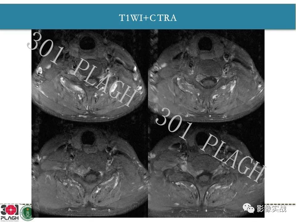 【病例】颈椎脊索瘤1例MR影像-7