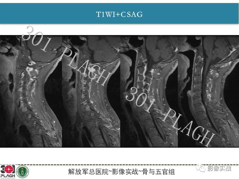【病例】颈椎脊索瘤1例MR影像-8