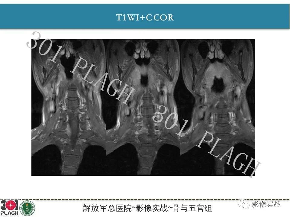 【病例】颈椎脊索瘤1例MR影像-9