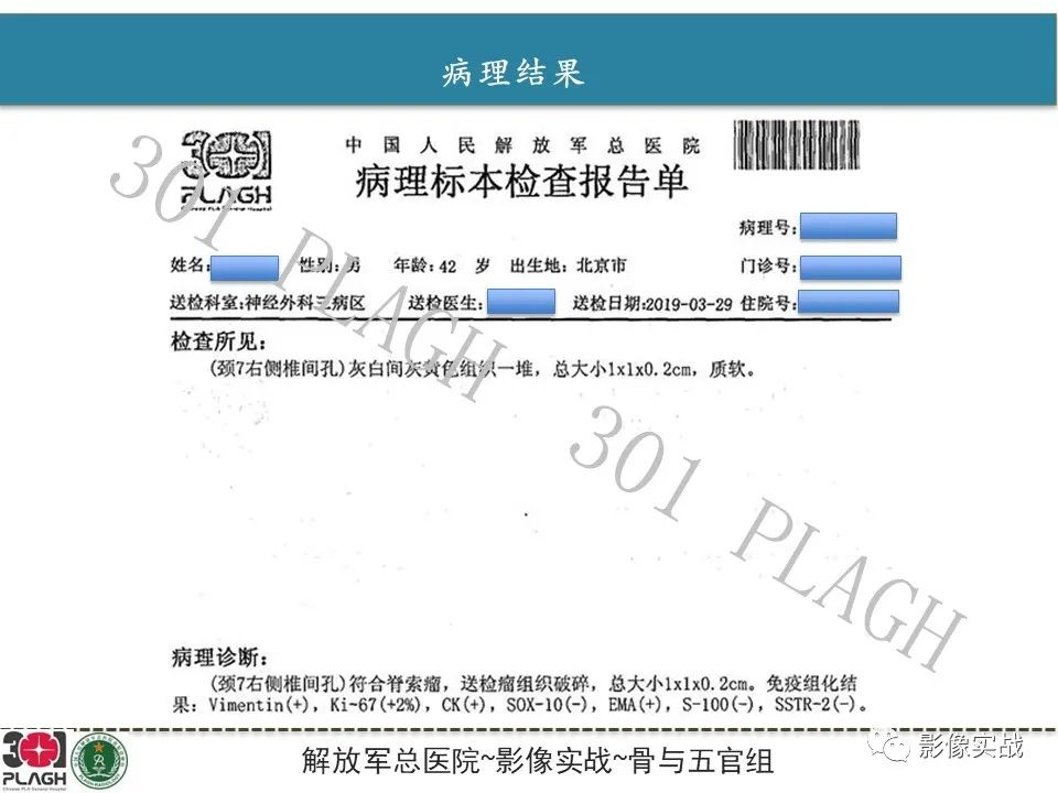 【病例】颈椎脊索瘤1例MR影像-12