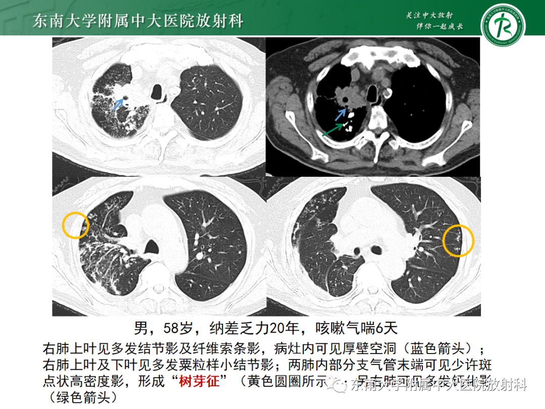 【PPT】肺脓肿-16