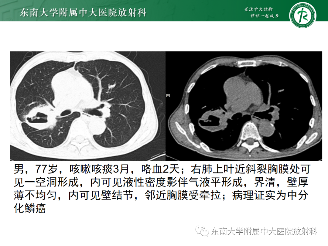 【PPT】肺脓肿-18