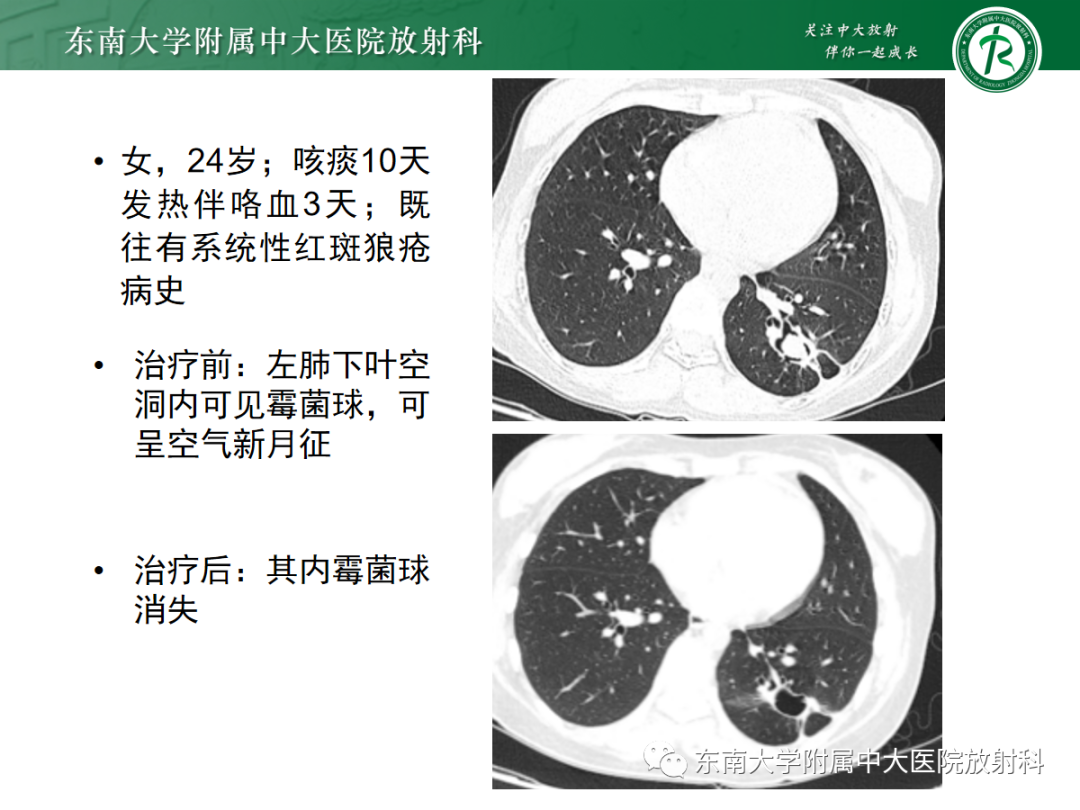 【PPT】肺脓肿-23