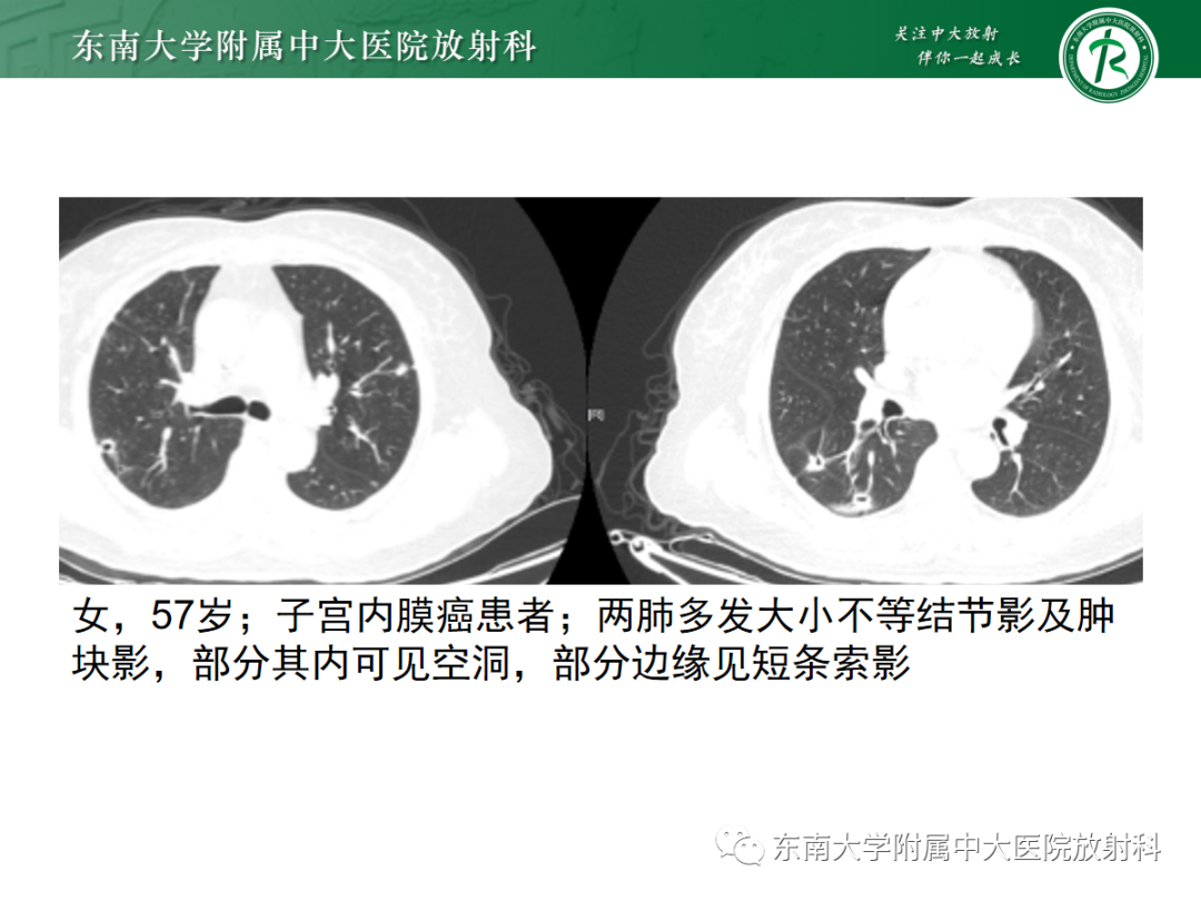 【PPT】肺脓肿-21